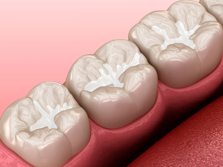 Tratamiento empastes dentales