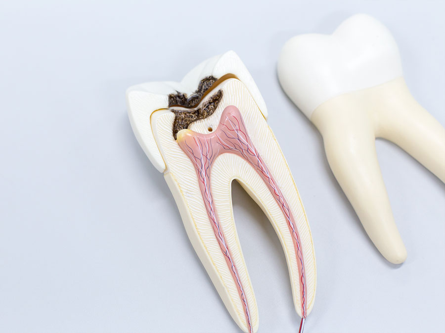 Tratamiento endodoncia