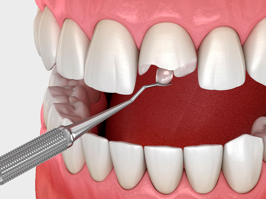 Reconstrucciones dentales